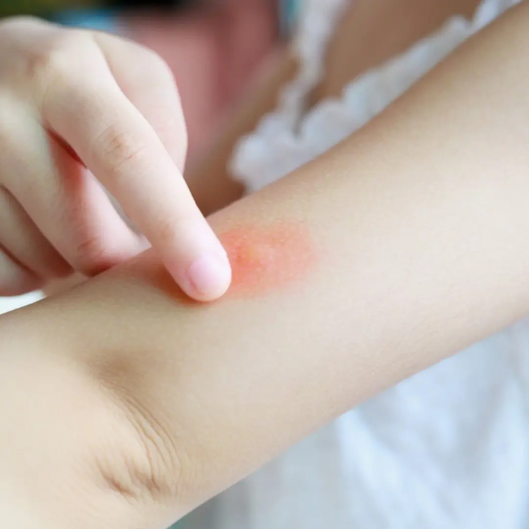 Dealing with Bug Bites & Stings This Spring: Your Comprehensive Guide