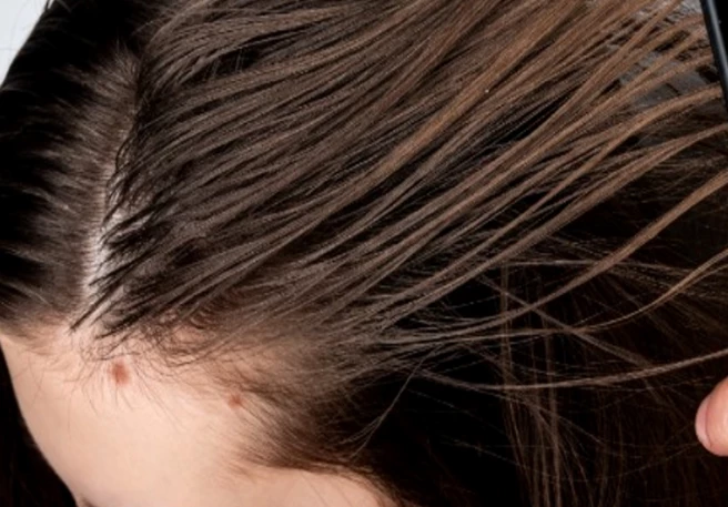 Oily scalp: Why you have it and how to prevent it