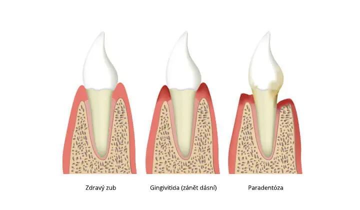 Periodontitis caused by inflammation of the gums